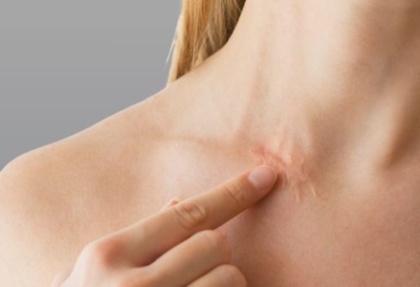 Surgical Scar Revision vs Chemical Peels: Which Is Better?