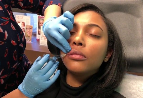 Why Do People Choose Lip Lift Over Lip Fillers for Results?