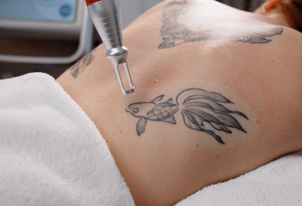 Why Do Some Tattoos Fade Faster With Laser Treatment?