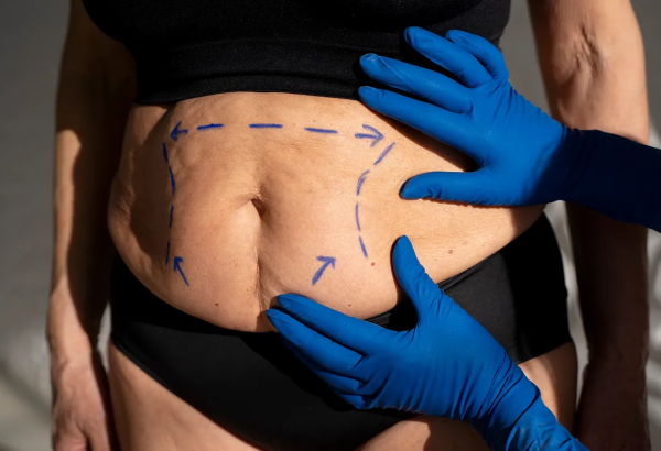 Can Liposuction Successfully Eliminate Stubborn Fat Deposits?