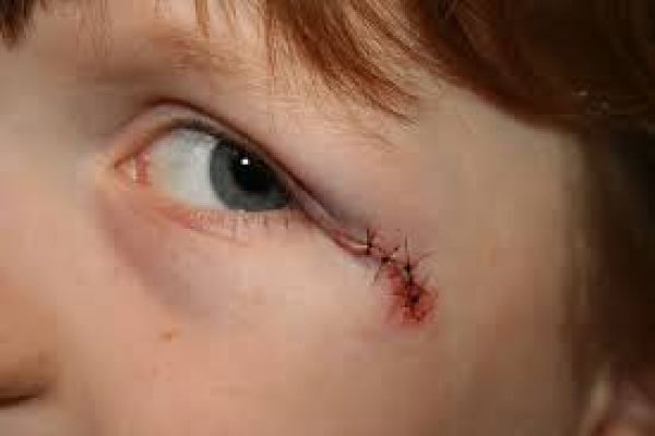 How Does Facial Scar Revision Work?