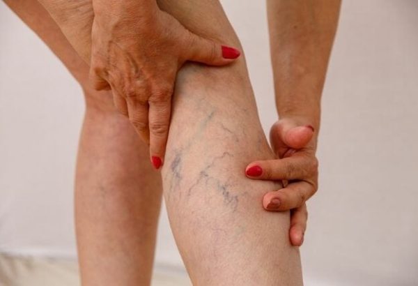 Are Varicose Veins a Serious Health Concern?