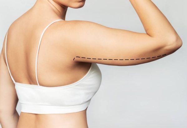 Can Arm Lift Surgery Improve Arm Shape?