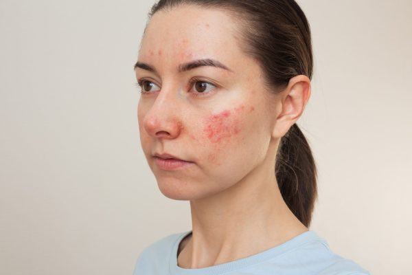 Is Rosacea Treatment relevant to skin health