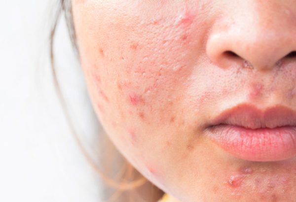 Can Acne Treatment Restore Skin Confidence?