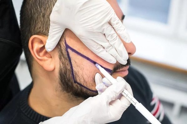 Complete Guide to Beard Restoration Strategies