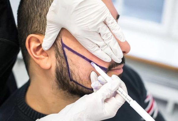 Complete Guide to Beard Restoration Strategies