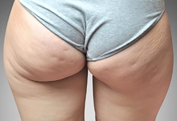 What Should You Expect From Cellfina Treatment?