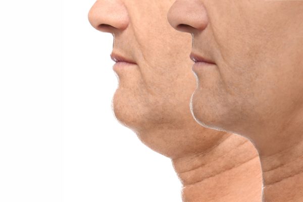 Double Chin Removal: What to Know Before You Decide