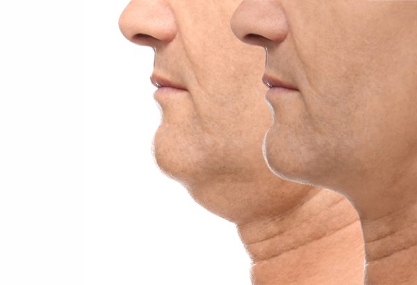 Double Chin Removal: What to Know Before You Decide