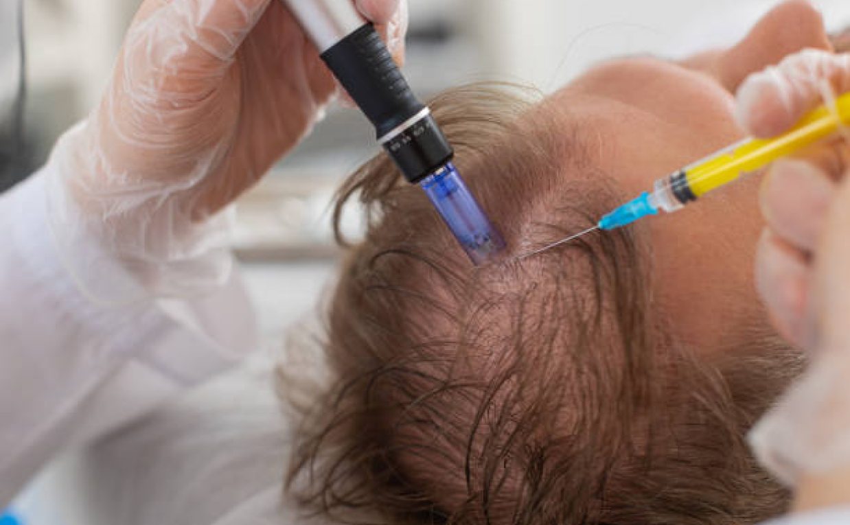 Exosome Hair in Dubai: Enhance Scalp and Hair Health