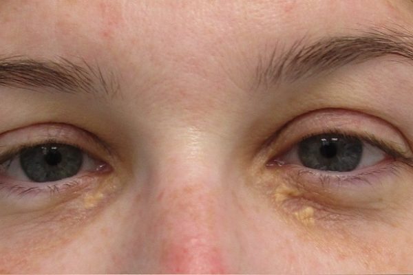 Eyelid Xanthelasma Removal for Stubborn Cholesterol Deposits Around the Eyes