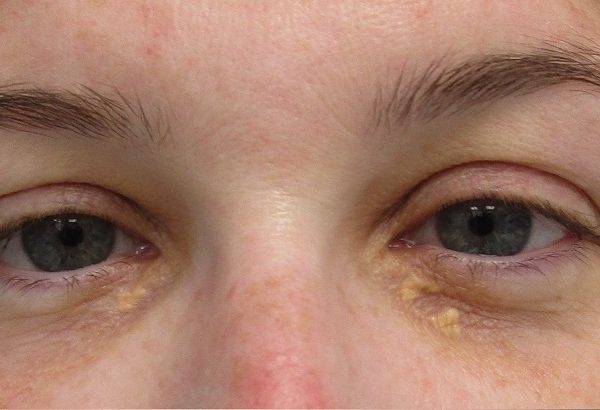Eyelid Xanthelasma Removal for Stubborn Cholesterol Deposits Around the Eyes