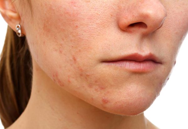 How Does Best Pimples Treatment Control Excess Oil Production?