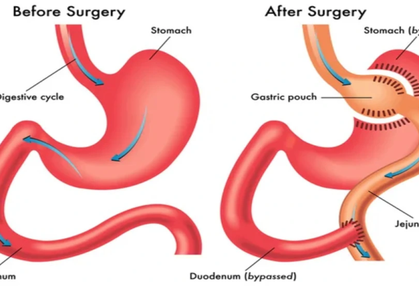 How Does Gastric Bypass Support Long-Term Weight Loss?