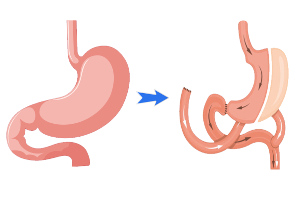 Is Gastric Bypass a Safe Weight Loss Procedure?