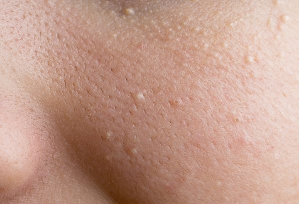 Is Milia Treatment Worth Considering for Clearer Skin?