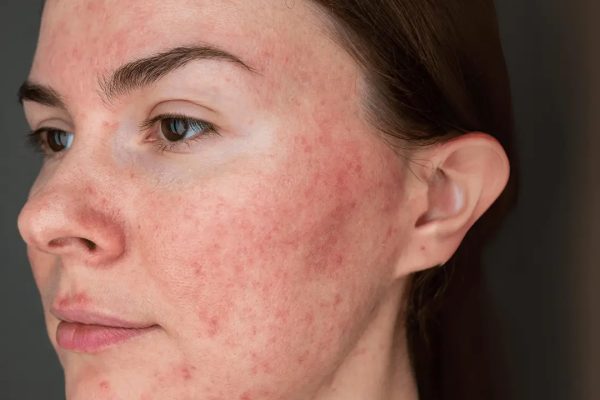 Is Rosacea Treatment relevant to skin health