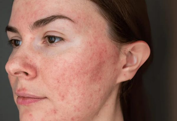 Is Rosacea Treatment relevant to skin health