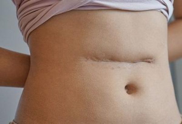 What Are the Main Goals of Scar Revision Surgery?