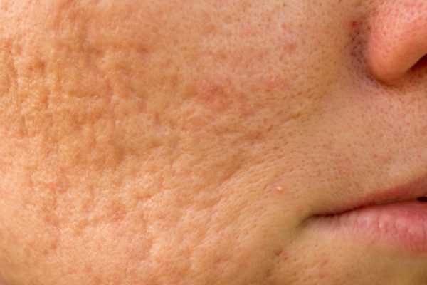 What do Acne Scar Treatments involve in clinical practice