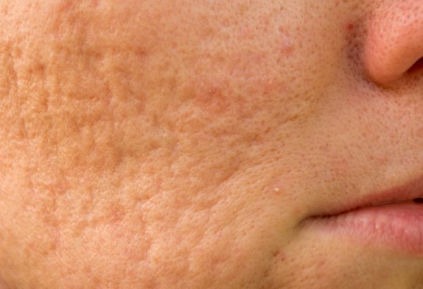 What do Acne Scar Treatments involve in clinical practice