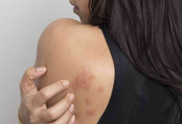 What Is the Best Treatment for Keloid Scars?