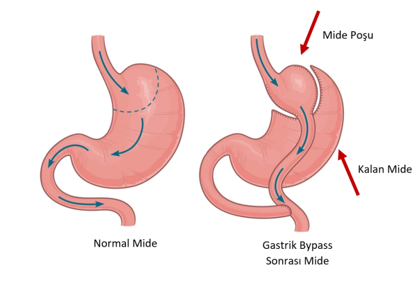 What Results Can You Expect From Gastric Plication?