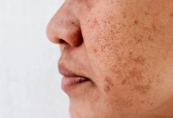 Effective Pigmentation Removal for Even Skin Tone
