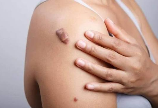 Don’t Ignore That Scar—Learn How to Manage Keloids Today