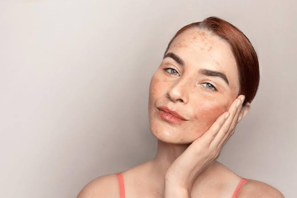 Affordable Pigmentation Removal Treatments Explained