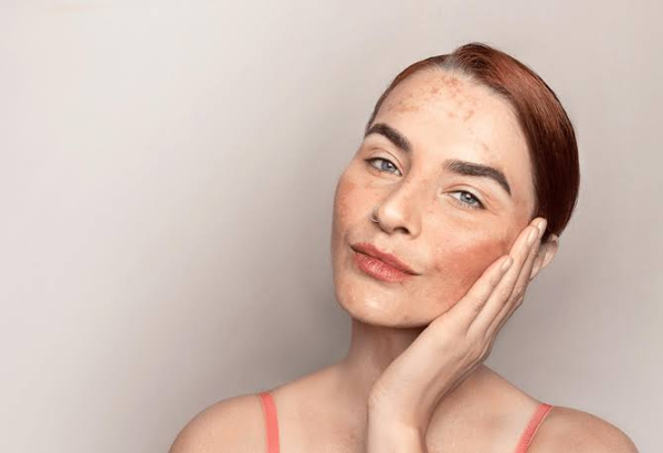 Affordable Pigmentation Removal Treatments Explained