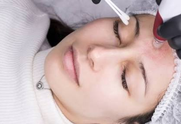 Mesotherapy Treatment: Benefits, Costs, and Risks