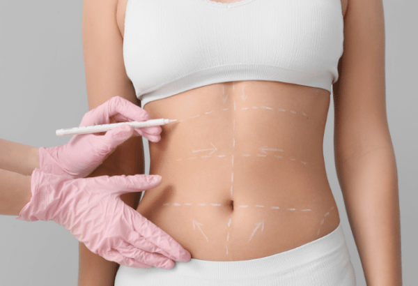 Is a Tummy Tuck Effective for Aging Skin?