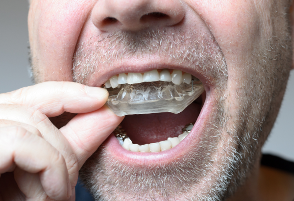 What Types of Mouth Guards Are Available?