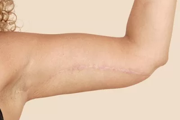 Is Arm Lift Surgery a Safe Procedure?