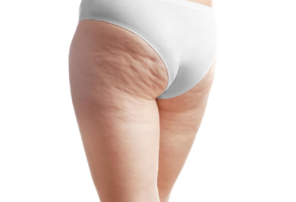 Why Choose Cellfina Treatment for Cellulite Removal?
