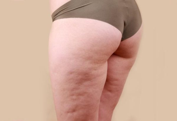 What Makes Cellfina Treatment Different from Others?