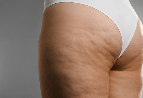Why Choose Cellfina Treatment for Cellulite Removal?