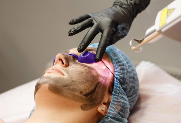 7 Things Patients Look for in a Laser Carbon Peel Clinic