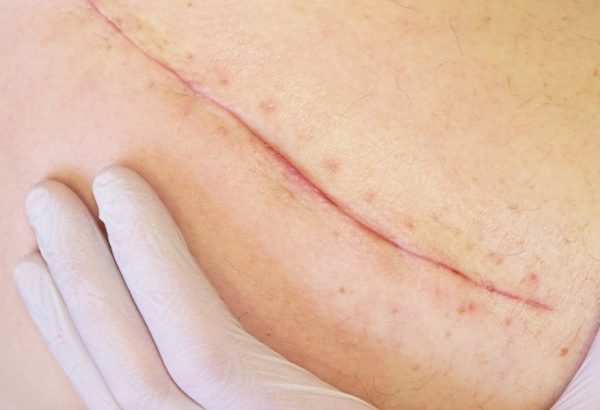 Can Surgical Scar Revision Improve Scar Appearance?