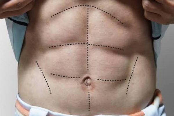 Leading Aesthetic Centers for Six Pack Abs in Dubai