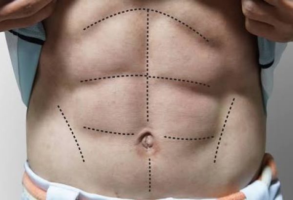 Leading Aesthetic Centers for Six Pack Abs in Dubai