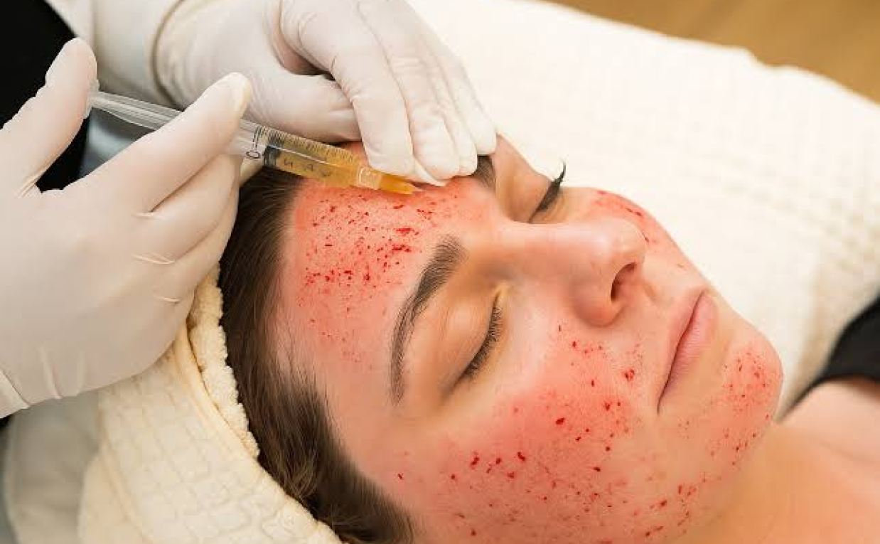 Vampire Facial Treatment for Youthful Skin