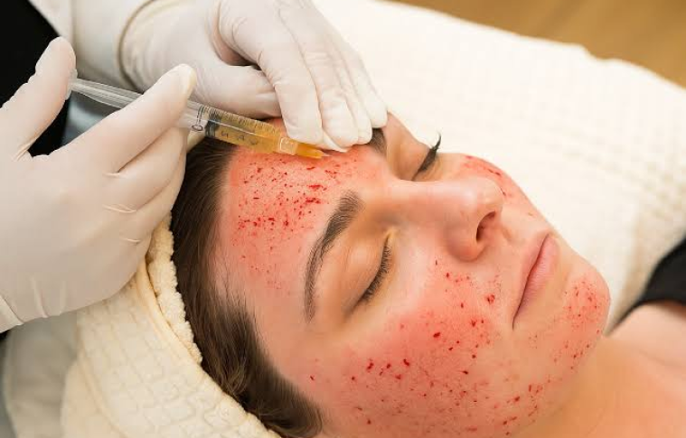 Vampire Facial Treatment for Youthful Skin