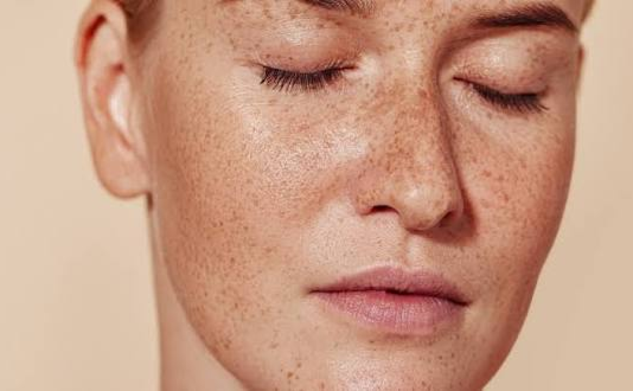 Best Pigmentation Treatment Recommended by Experts