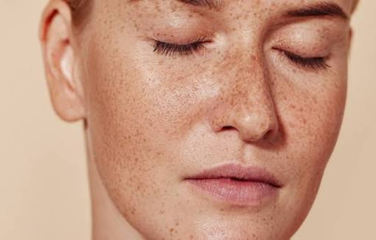 Best Pigmentation Treatment Recommended by Experts
