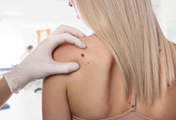 Can Large Moles Be Removed with Treatment?