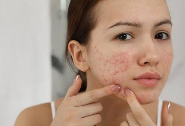 What Should You Know About Acne Treatment?