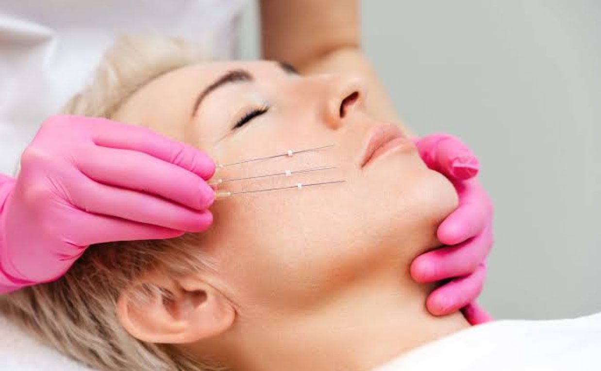 How Does Thread Lift Relate to Collagen Activity?